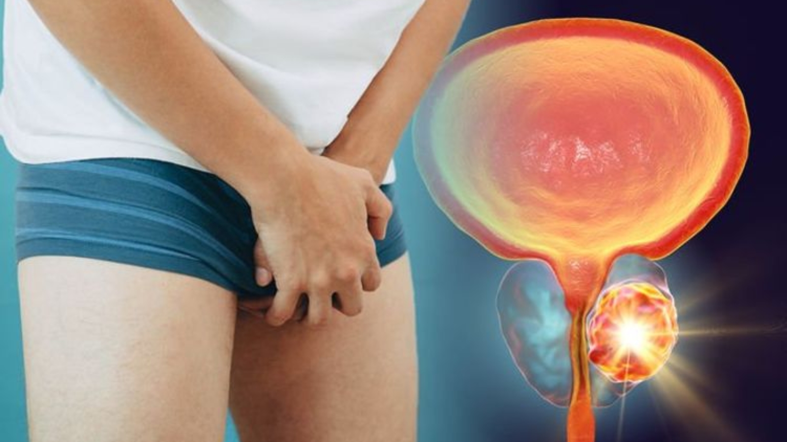 Prostat Kanseri Nedir?