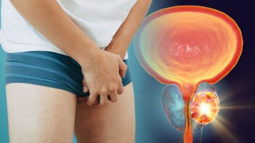 Prostat Kanseri Nedir?